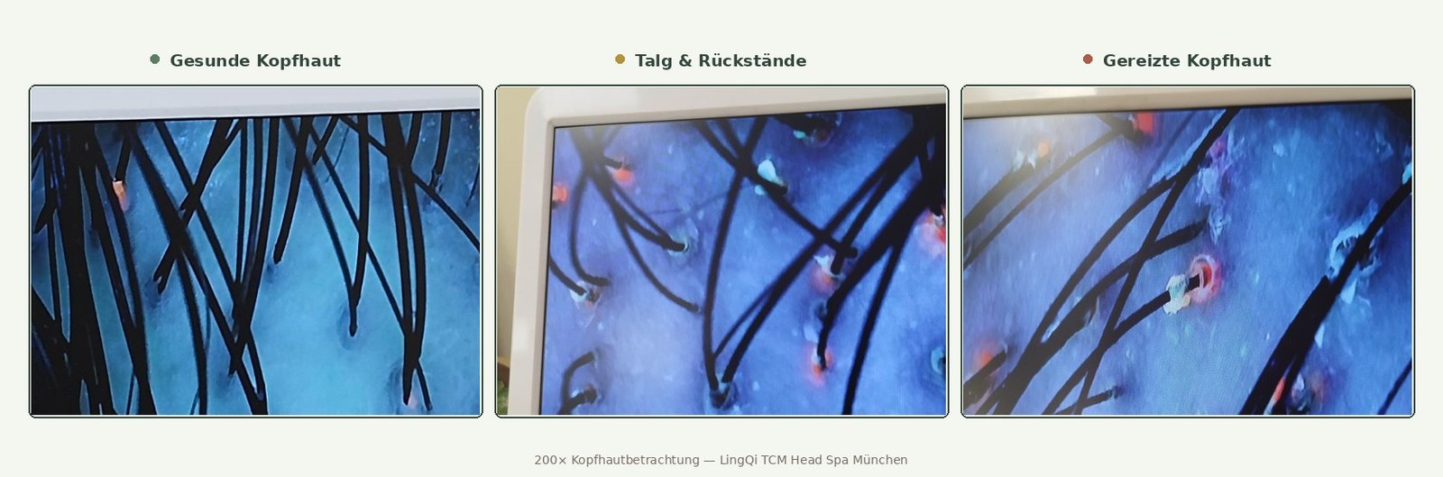 Kopfhautvergleich unter 200-facher Vergrößerung: gesunde Kopfhaut, übermäßiger Talg und Rückstände, gereizte Kopfhaut — LingQi TCM Head Spa München